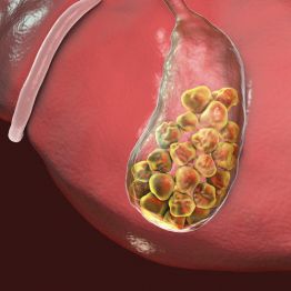 Өттегі тастар: өт көпіршігін алып тастау керек пе, әлде жоқ па?