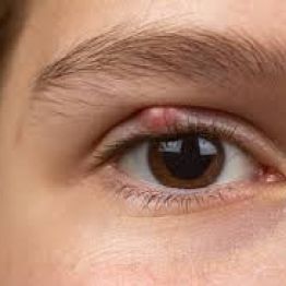 Шишка на веке – это халязион или ячмень?