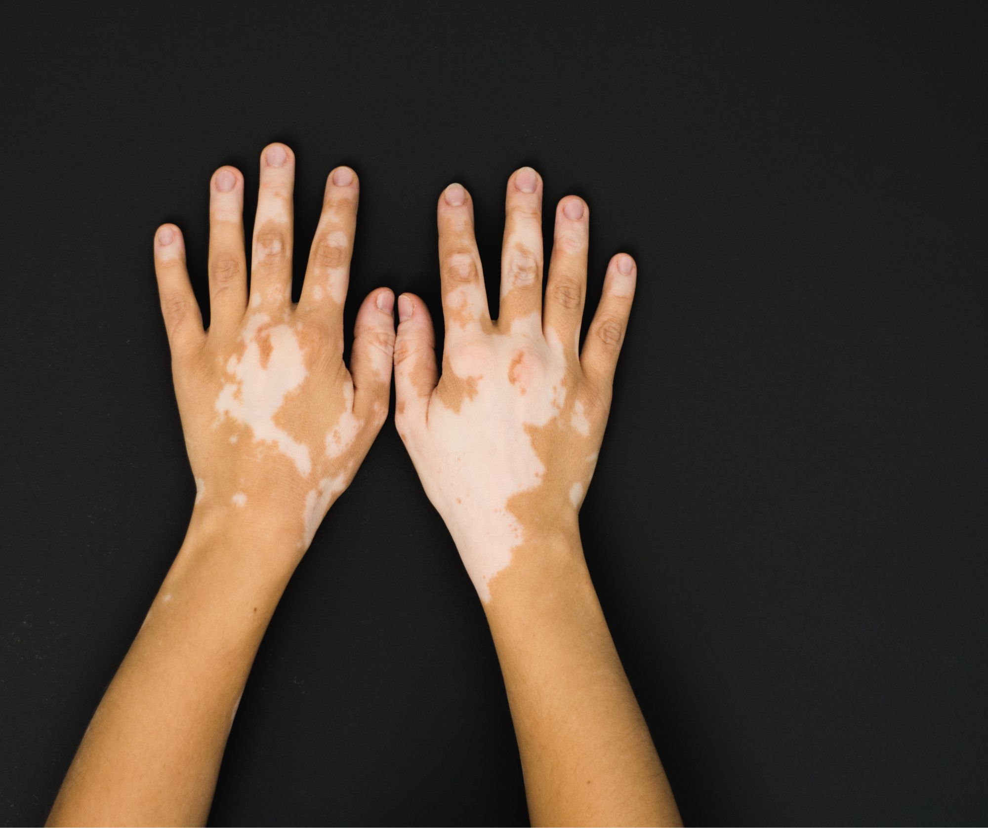 vitiligo_almaty2.jpg